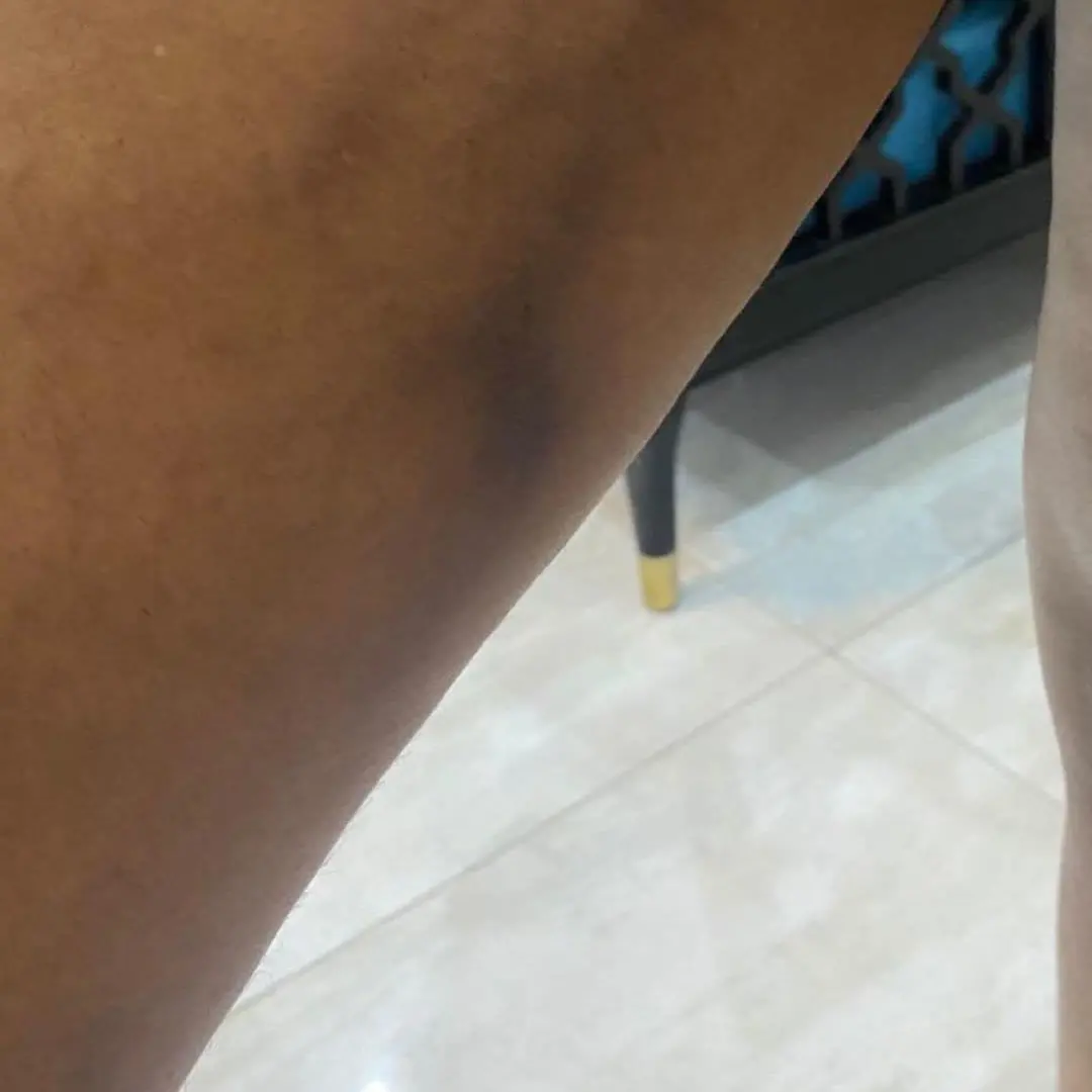 Best laser stretch mark removal in Enugu