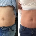 Fat Lipolysis