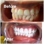 LASER teeth whitening