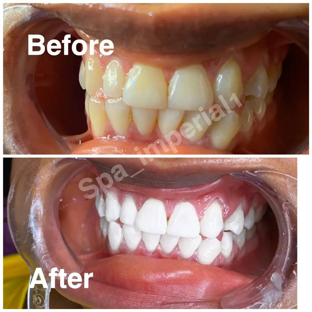 LASER teeth whitening