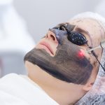 Carbon Laser Peel treatment