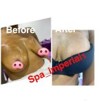 vacuum boob enlargement