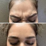 botox before and after
