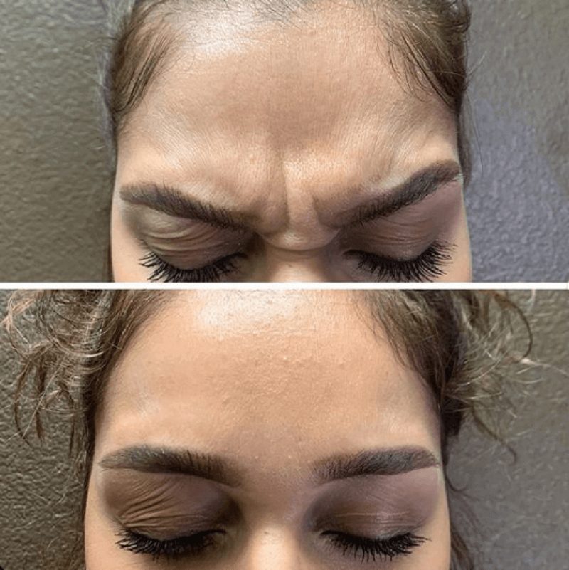 botox before and after
