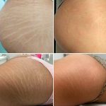 inkless stretch mark removal before and after