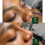 Non-Surgical Nose Job Transformation ✨Subtle changes. Beautiful balance. 💉This transformation