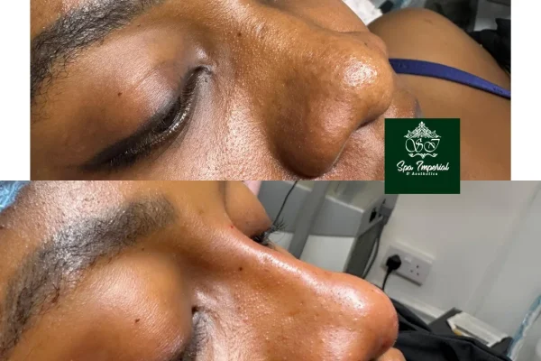 Non-Surgical Nose Job Transformation ✨Subtle changes. Beautiful balance. 💉This transformation
