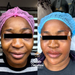 Non surgical face lift