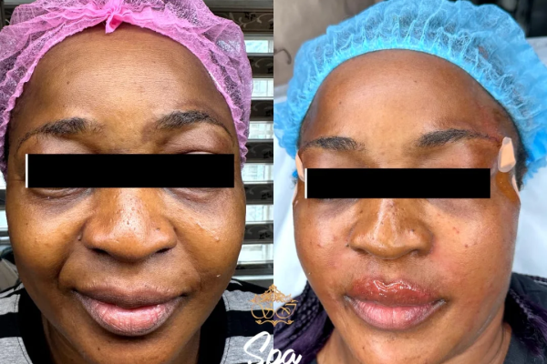 Non surgical face lift